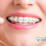 唇側矯正（表側矯正）とは