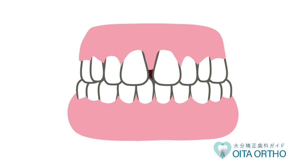 空隙歯列弓 すきっ歯 とは 大分 矯正歯科ガイド