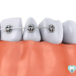 インプラント矯正(アンカースクリュー矯正)