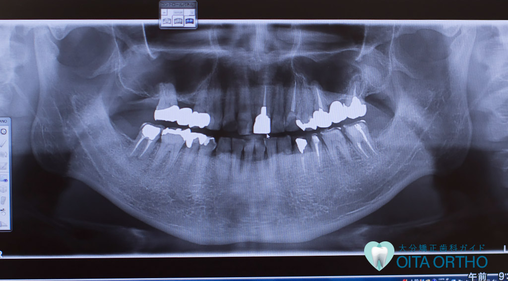 歯科の診断・治療に使われるX線