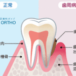歯周病の原因