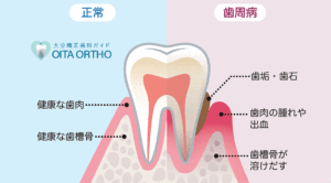 歯周病の原因
