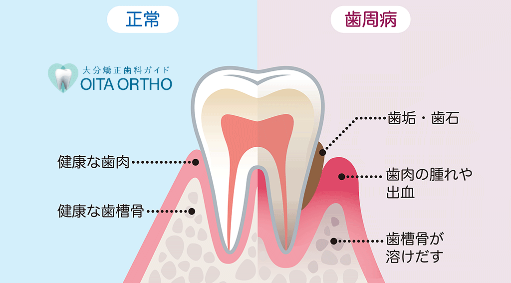 歯周病の原因