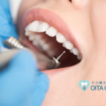 歯の神経を取るとどうなる?