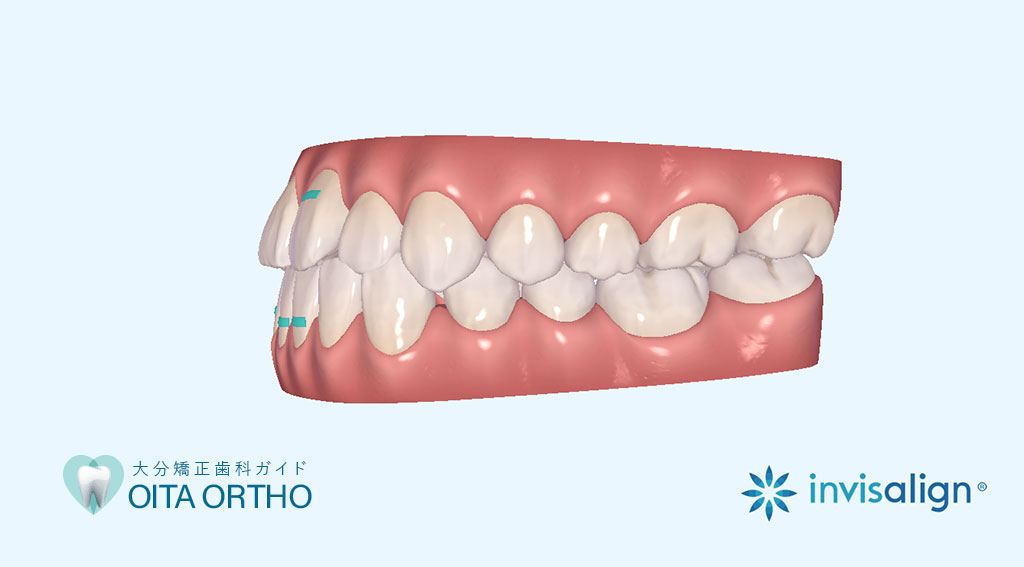 インビザラインのクリンチェックとは