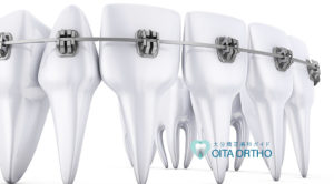 金属アレルギーでも歯列矯正できる?