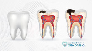 虫歯にならない人がいるのは本当ですか?